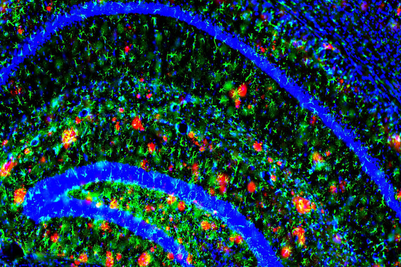 A new study reveals that the brain’s ability to clear the main ingredient of Alzheimer’s plaques slows with age (the plaques are red in this image). The findings could help explain why risk of the disease increases with age. Photo: John Cirrito