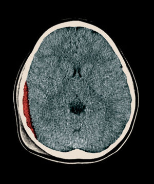 A CT scan shows the brain of a child with mild traumatic brain injury. The red area shows a subdural hematoma — a blood clot located between layers of the protective lining covering the brain (red color added to illustrate hematoma). A new risk scoring system developed by neurosurgeons at Washington University School of Medicine in St. Louis provides guidance on how best to manage such patients. 