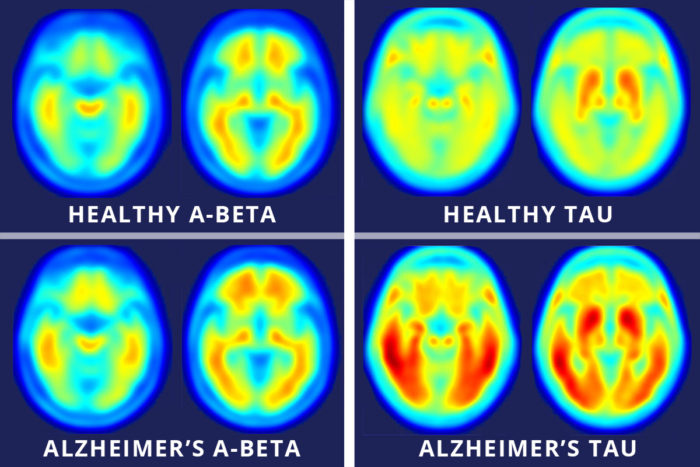 Images across the top show compilations of PET brain scans of people who are cognitively normal. Images across the bottom show compilations of PET brain scans of patients with symptoms of mild Alzheimer’s disease. The difference between scans of healthy people and scans of patients with mild Alzheimer’s disease is much more apparent in the images that measure tau (right four images), suggesting tau protein buildup in the brain is a better marker of Alzheimer’s disease symptoms than the long-studied amyloid beta buildup (left four images).